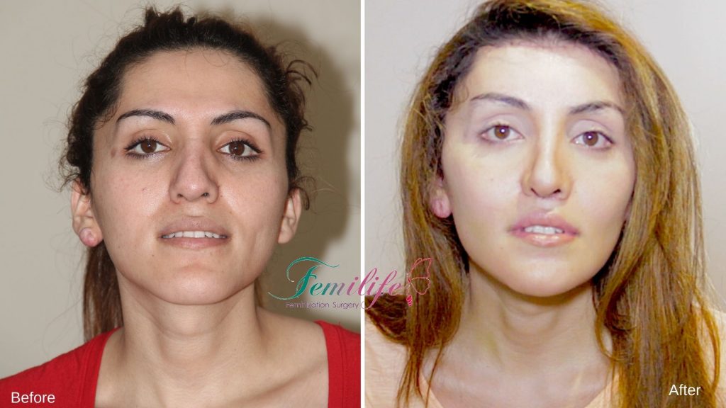 facial feminization surgery femilife