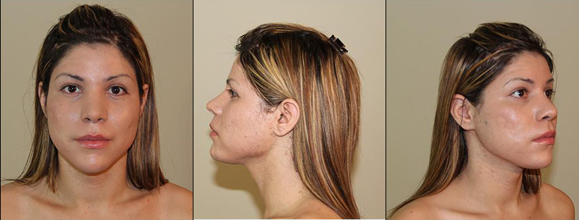 facial feminization surgeries