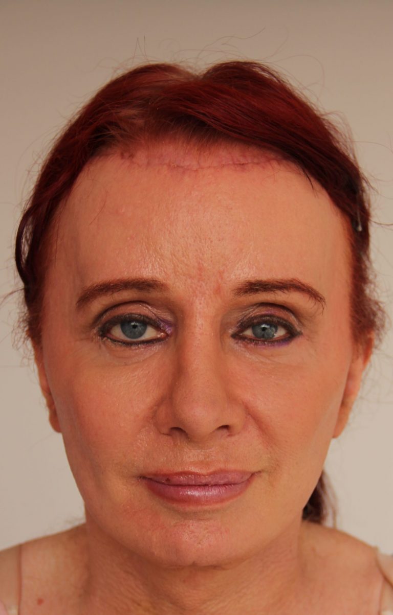 facelift and facial feminization surgery en femilife