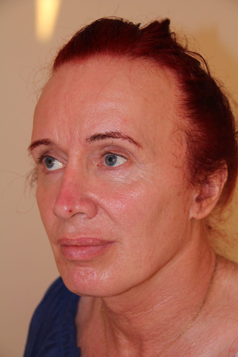 facial feminization surgery in femilife peru