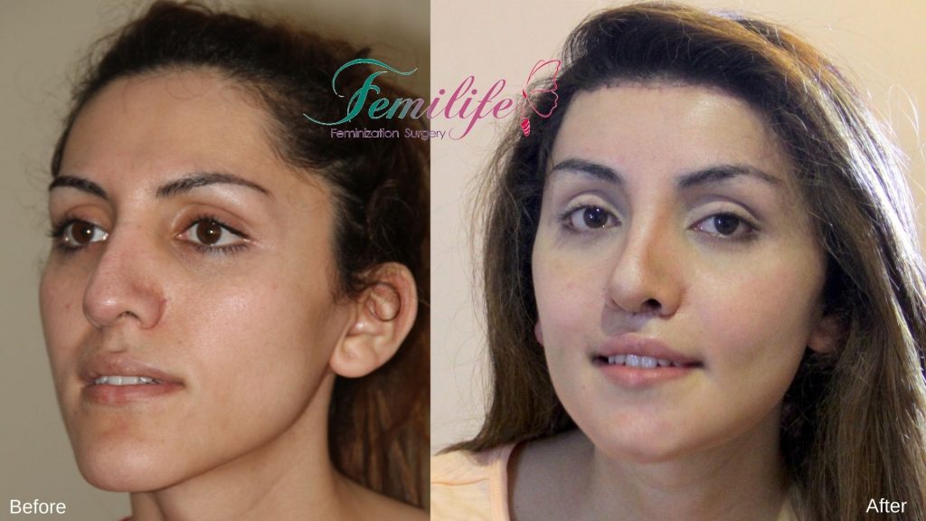 facial feminization surgery