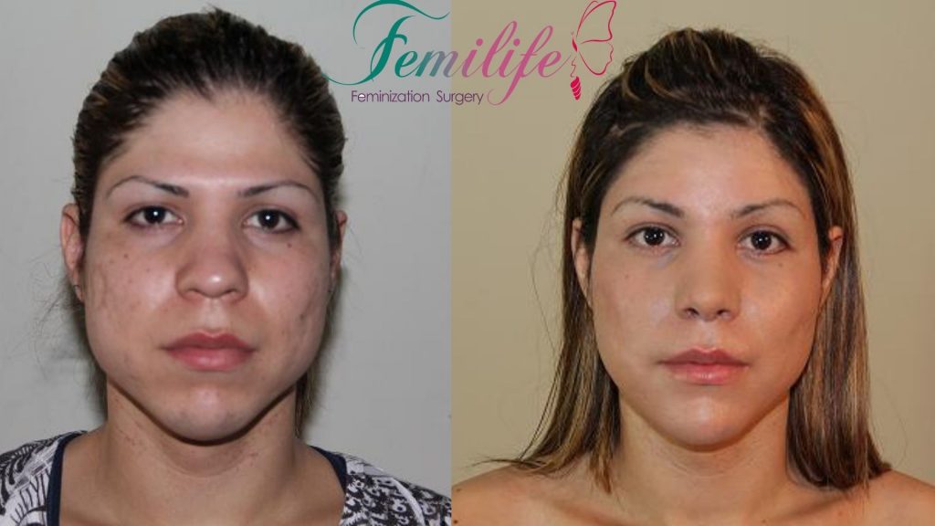 facial femenization surgery before and after