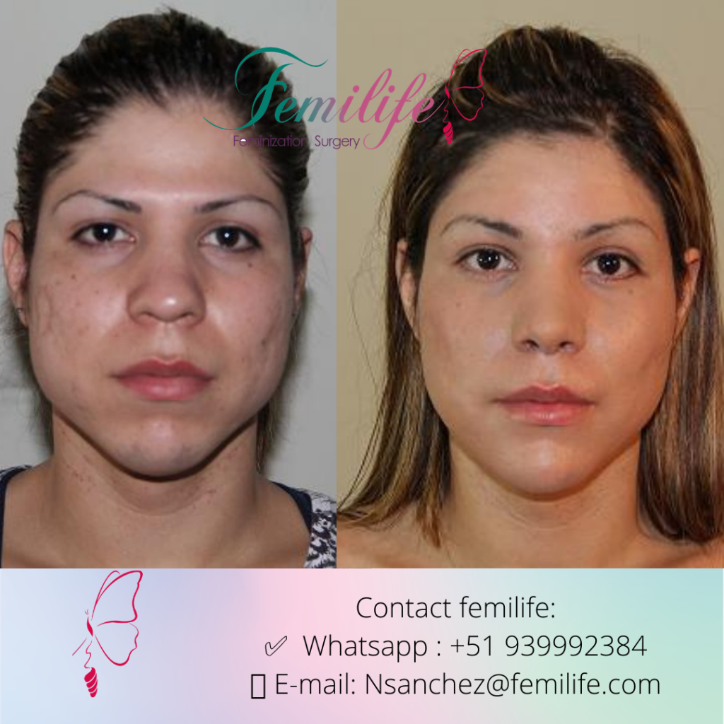 facial feminization surgery ffs