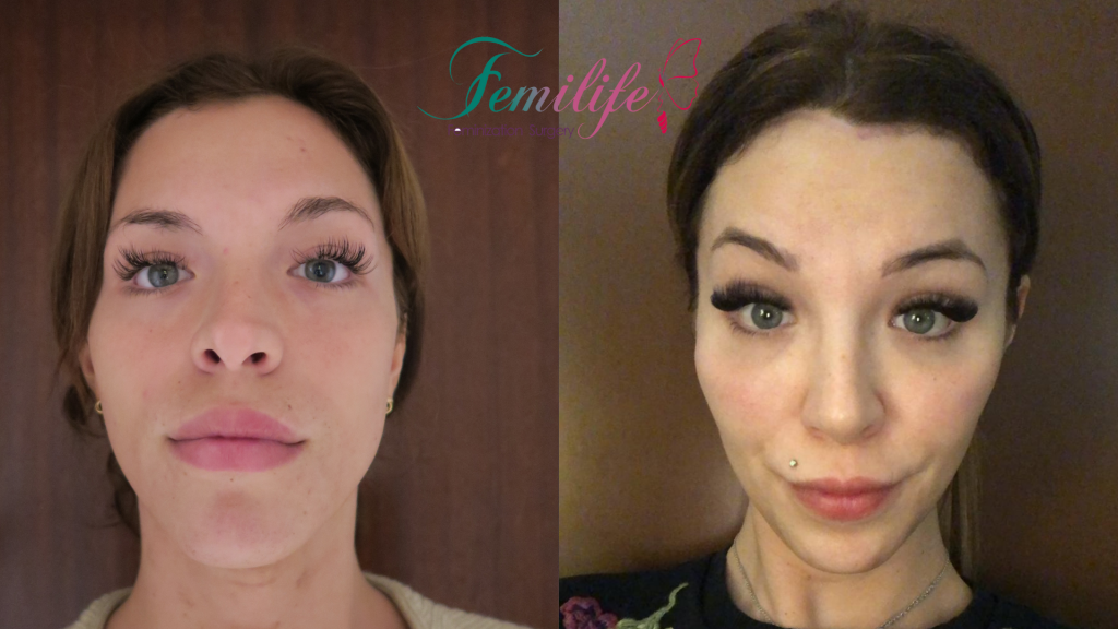 facial femenization surgery